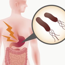 Helicobacter pylori - Human Stomach