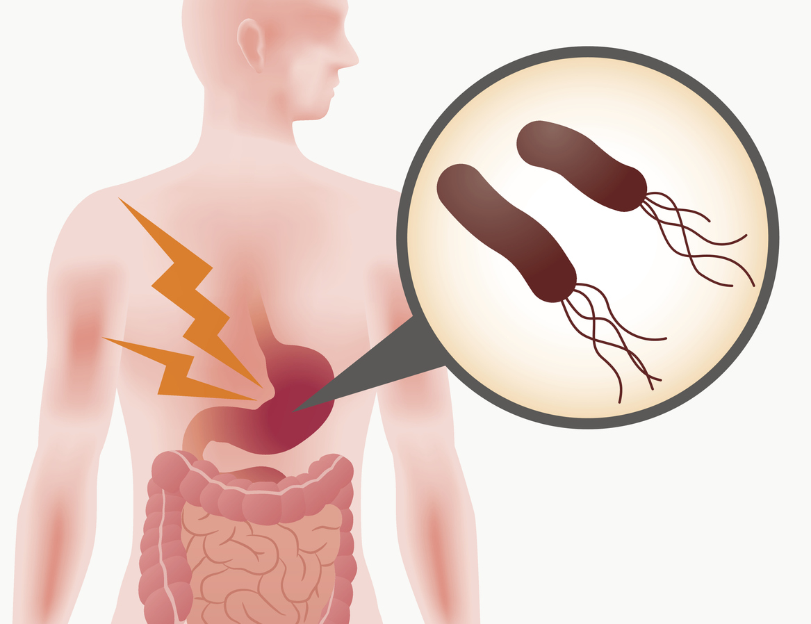 Helicobacter pylori - Human Stomach