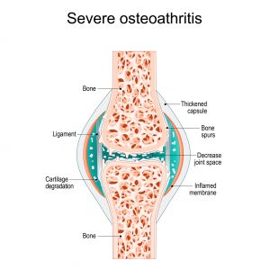 Magnesium for the Treatment of Osteoarthritis (OA) Joint Pain Relief