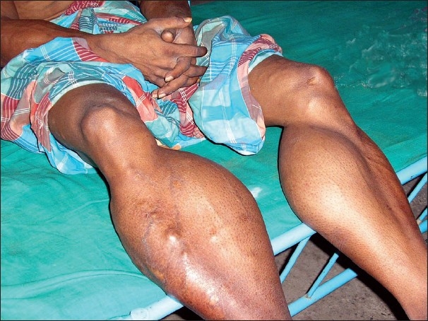 Cysticercosis with gross hypertrophy of calf muscles