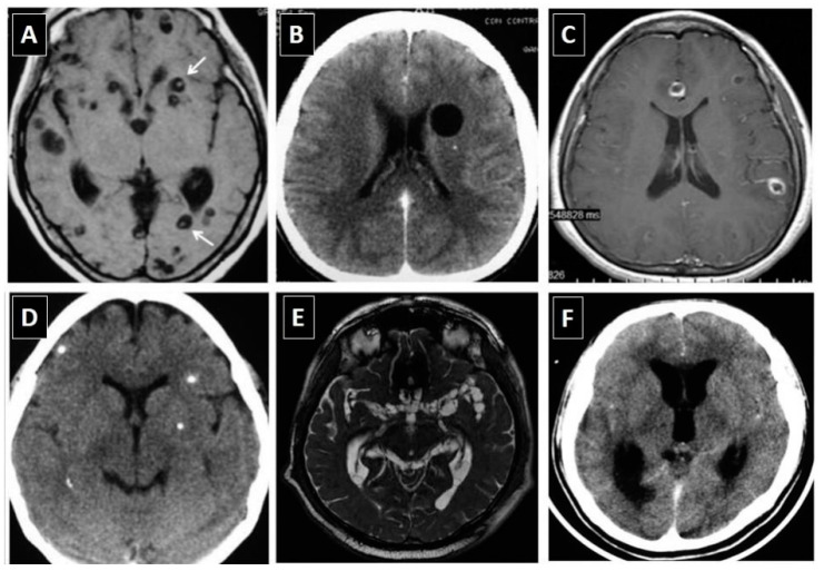 Taenia Solium Tapeworm Infection - Neuroimaging characteristics of neurocysticercosis